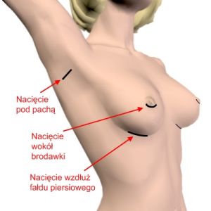 Powiększanie piersi - Wybór nacięcia